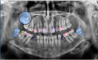 An innovative AI-powered software solution that automatically analyzes panoramic dental X-ray images
